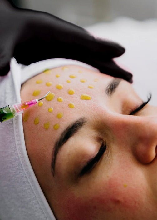 Acne Treatment by Beauty Culture MedSpa at Beauty Culture MedSpa