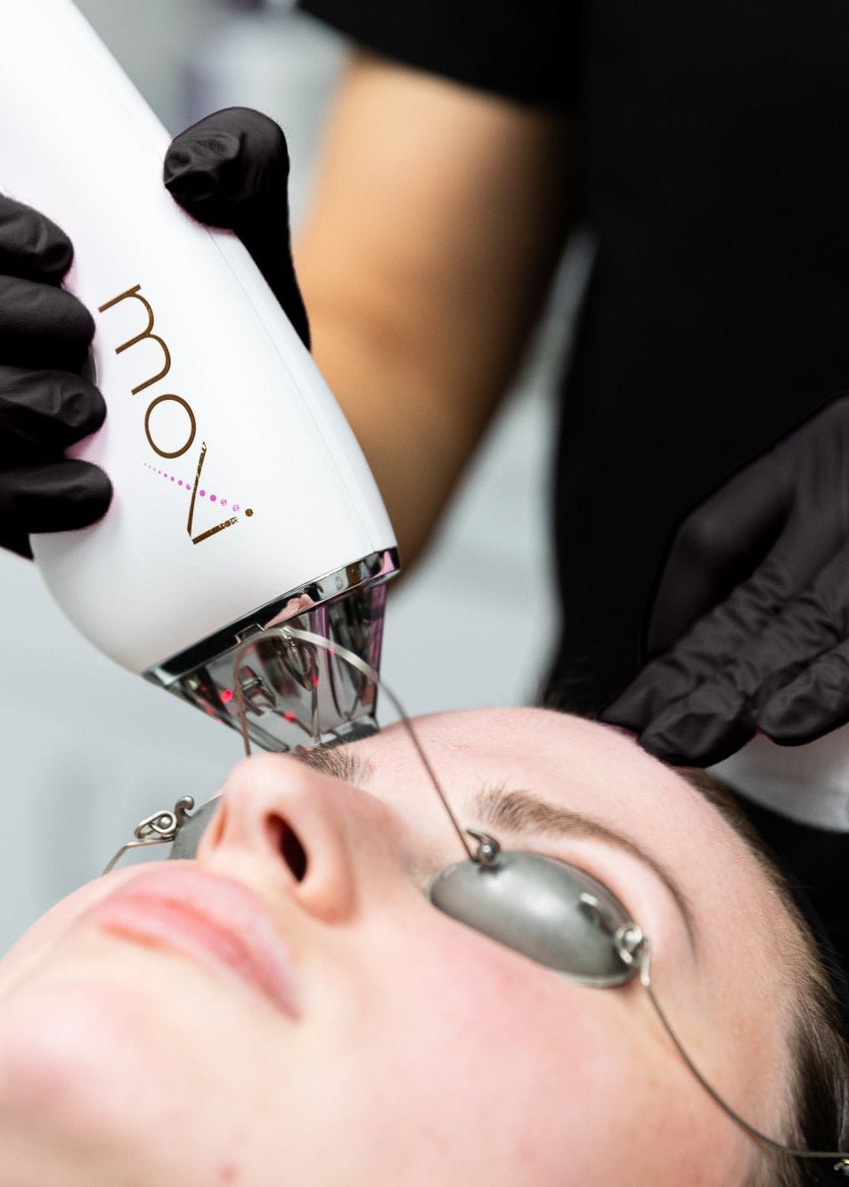 MOXI™ Laser Treatment by Beauty Culture MedSpa at Beauty Culture MedSpa