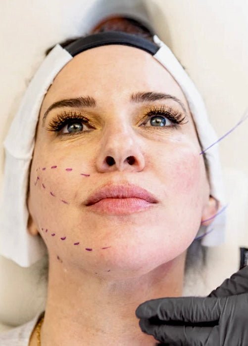 PDO Thread Lift by Beauty Culture MedSpa at Beauty Culture MedSpa