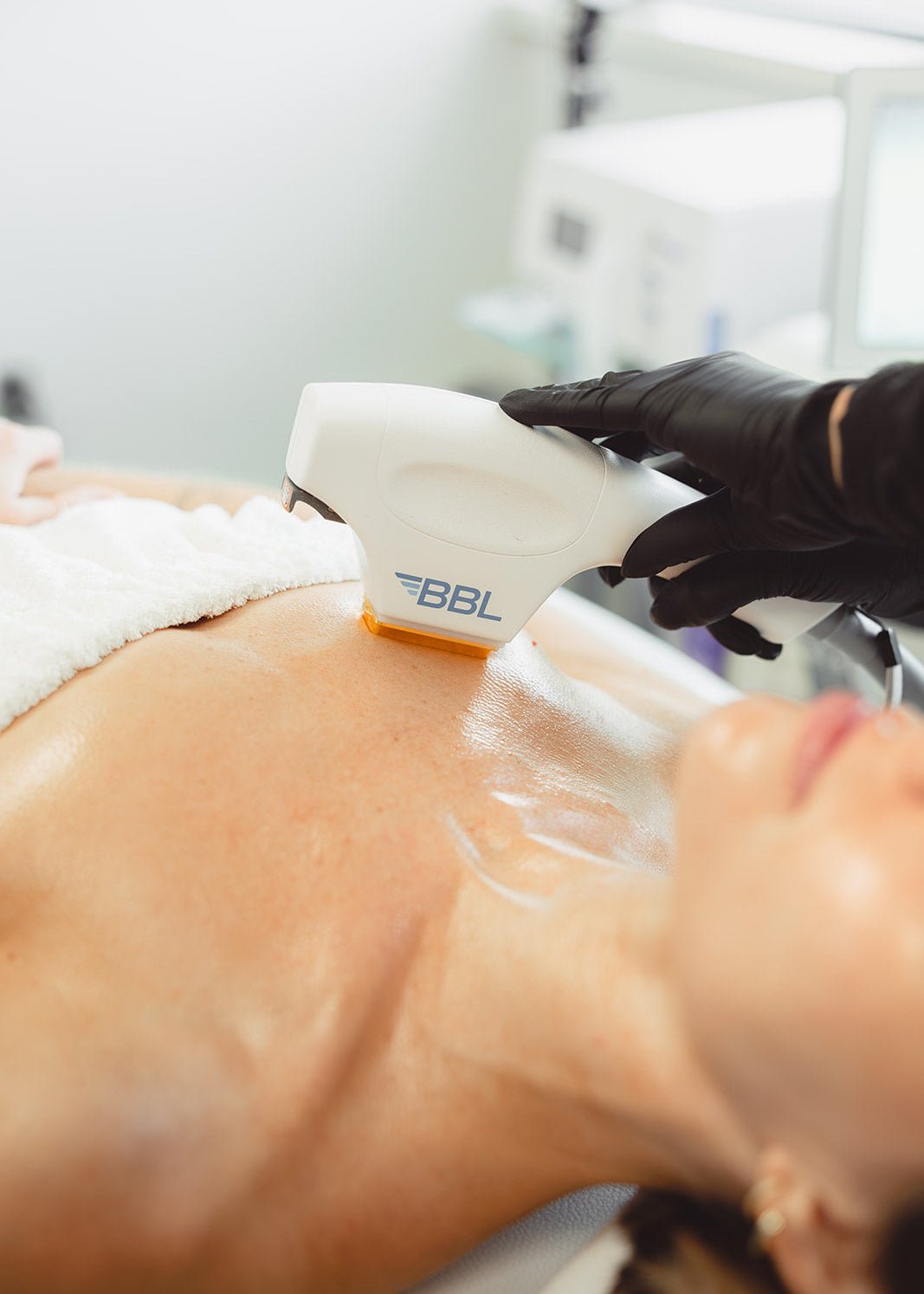 BBL Photofacial by Beauty Culture MedSpa at Beauty Culture MedSpa
