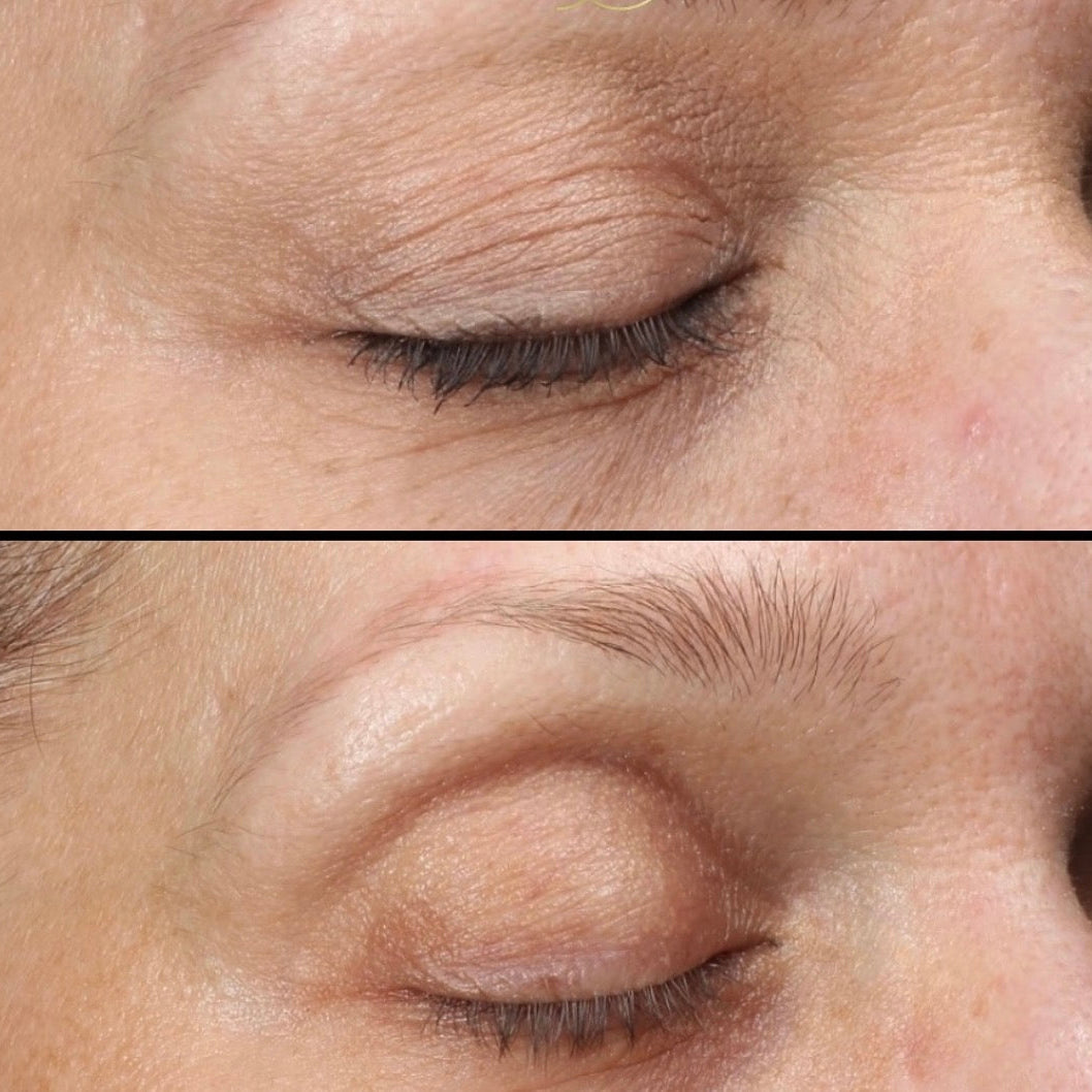 Close-up of a person's eye with visible wrinkles before and after treatment.
