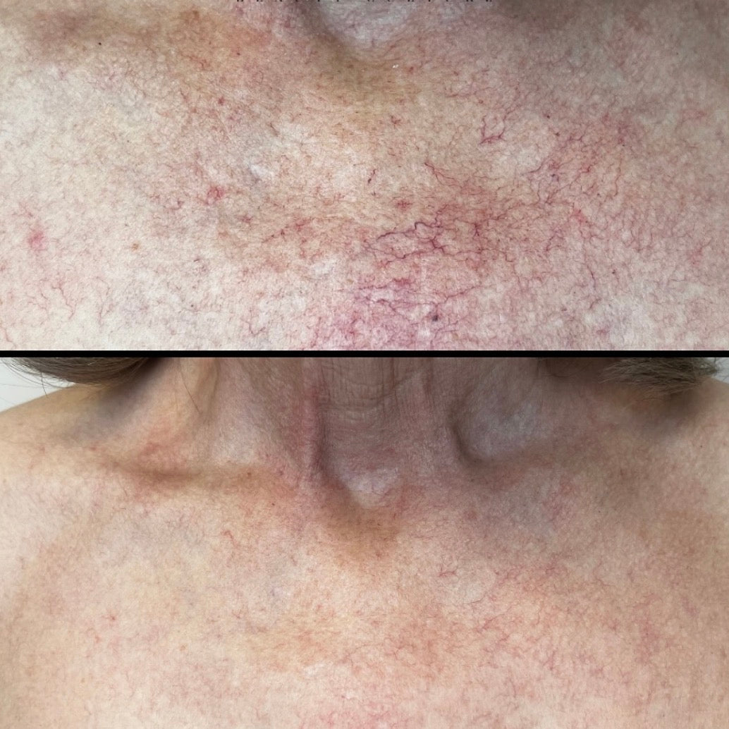 Before and after comparison of skin texture on a person's neck.