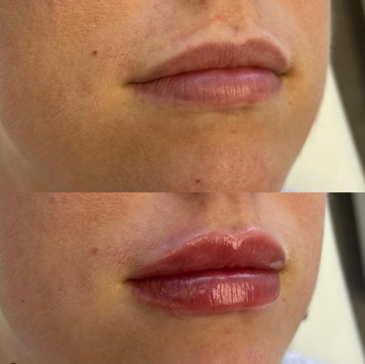 Before and after comparison of lips with a neutral background